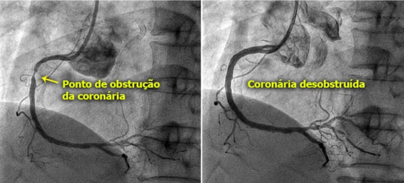 Angiografia coronária mostrando o ponto de obstrução da artéria antes da angioplastia e a coronária desobstruída após o procedimento