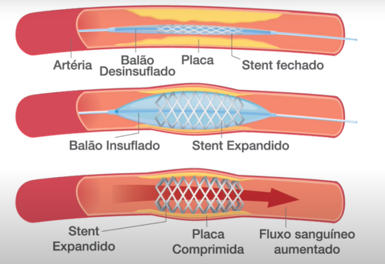 Ilustração do mecanismo da angioplastia: balão desinsuflado com placa, balão insuflado expandindo o stent, e stent expandido comprimindo a placa e aumentando o fluxo sanguíneo
