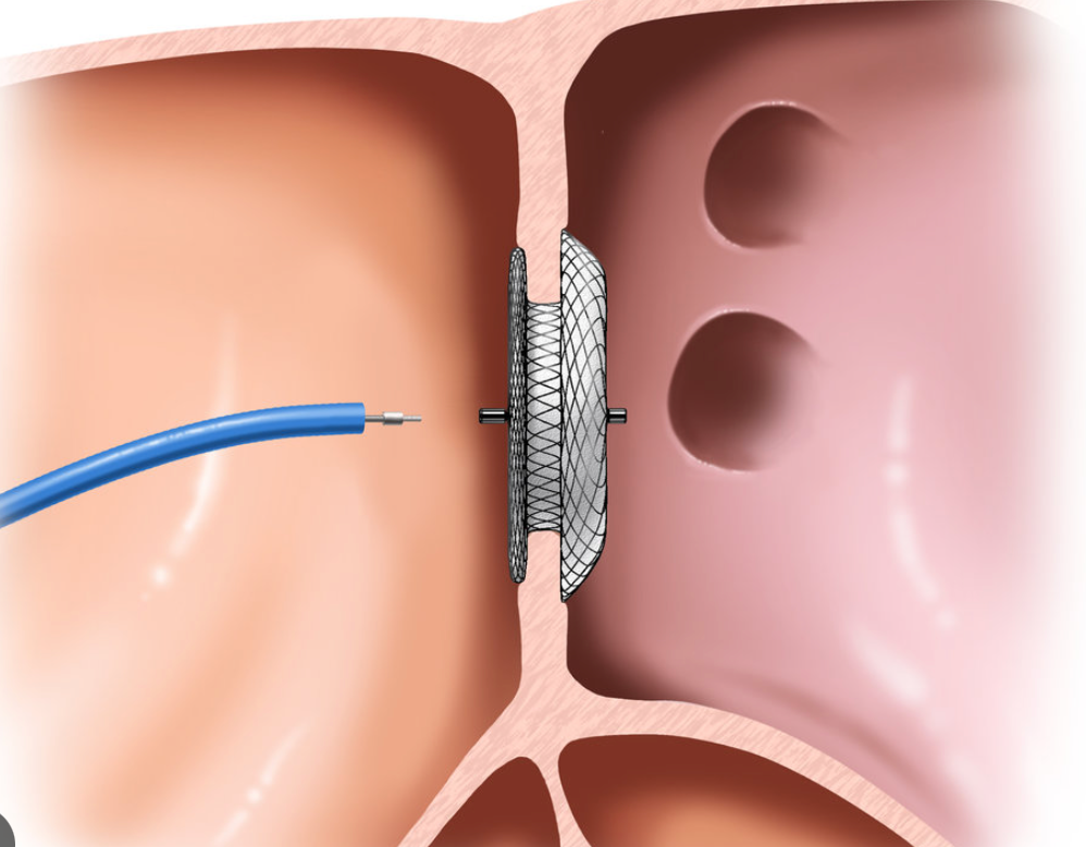 Ilustração do dispositivo oclusor posicionado dentro do septo interatrial, com os dois discos abertos de cada lado do defeito