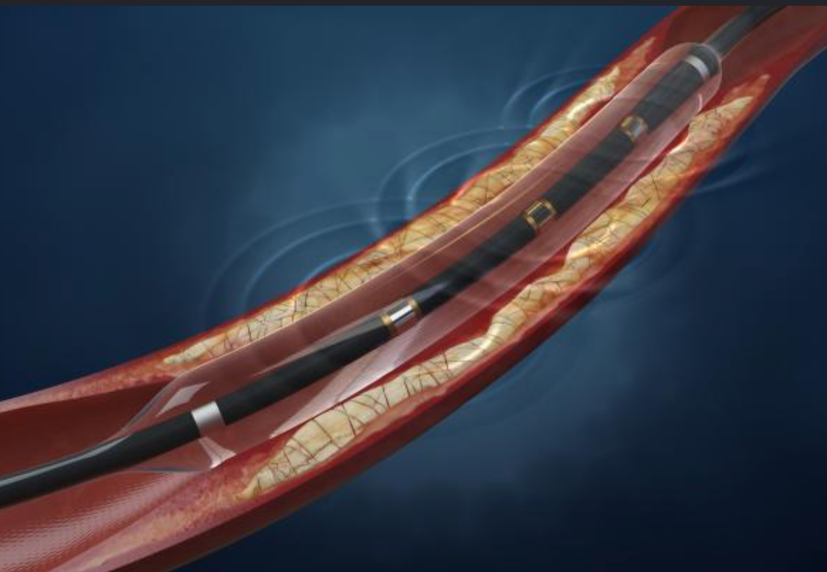 Ilustração do balão de litotripsia intravascular (Shockwave) dentro de uma artéria coronária calcificada, emitindo ondas de choque para fraturar o cálcio da placa